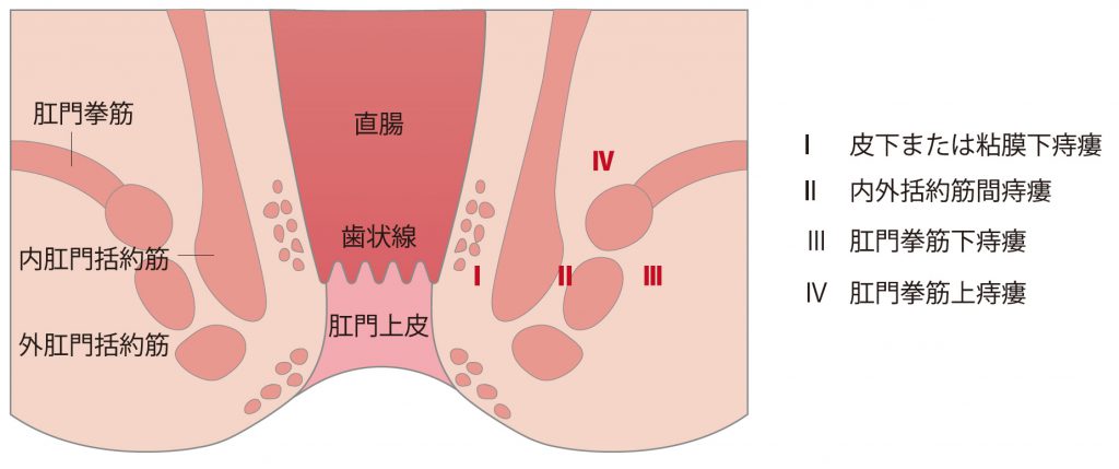 痔瘻の隅越分類