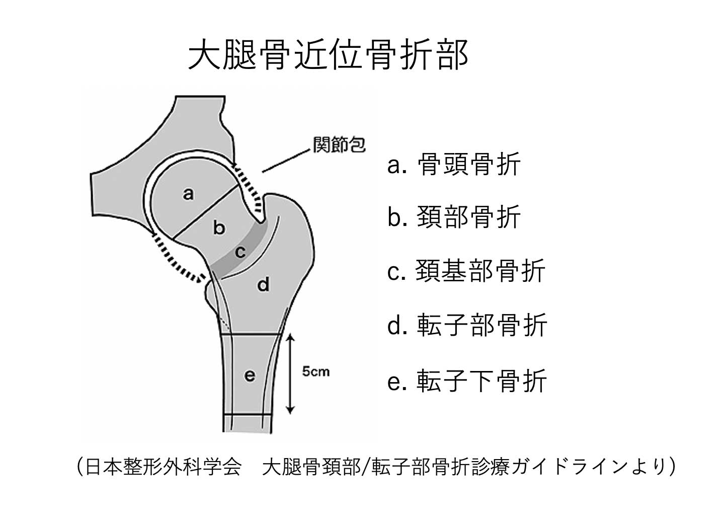 大 転 子 大腿 骨