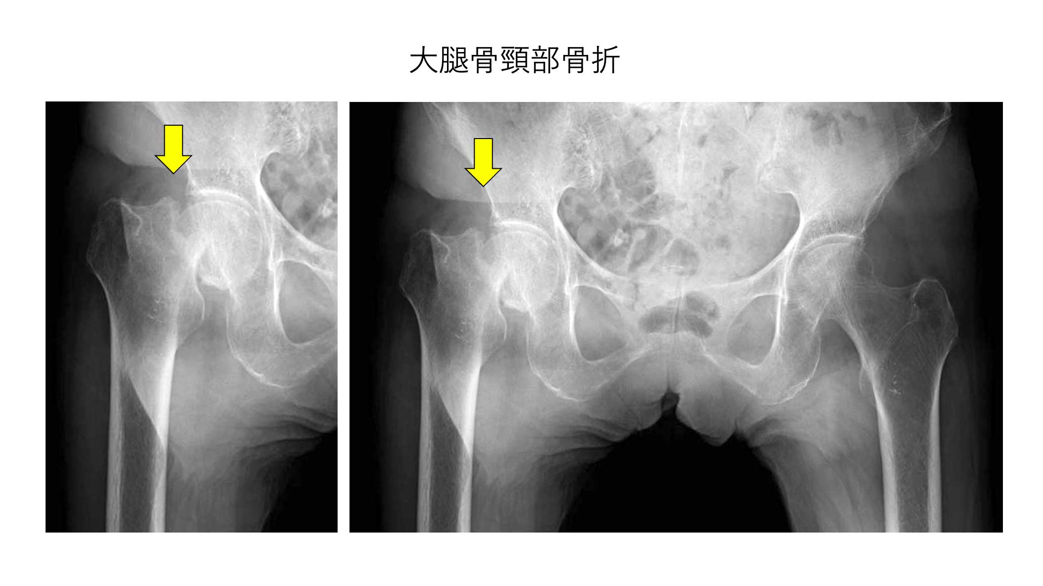 部 転 骨折 大腿 骨 子