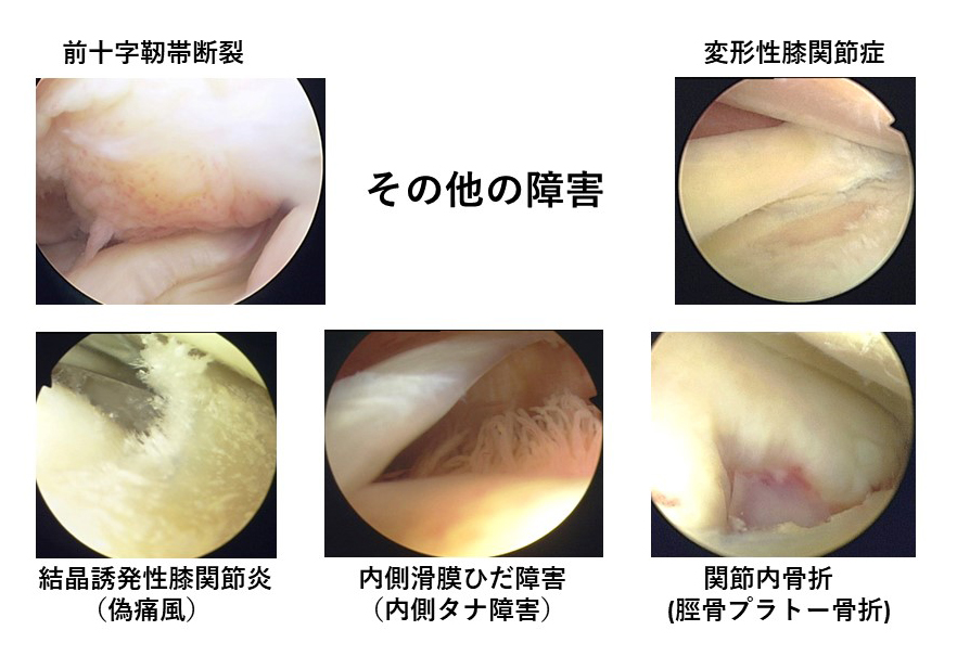 膝関節痛に対する膝関節鏡 松山市救急指定病院 医療法人ミネルワ会 渡辺病院